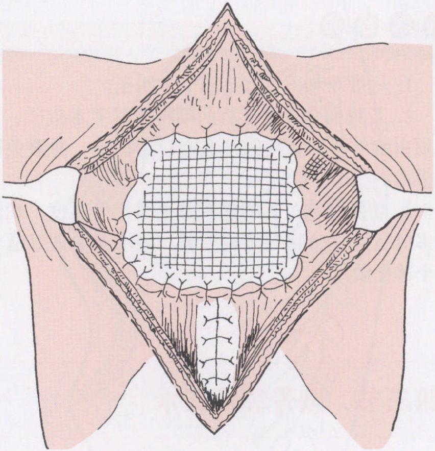 第三節(jié) 胸骨裂矯正術(shù)